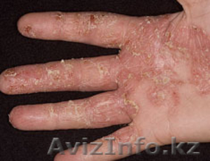 Лечение кожных заболеваний (экзема, дерматит, псориаз, ожоги). - Изображение #2, Объявление #1210912