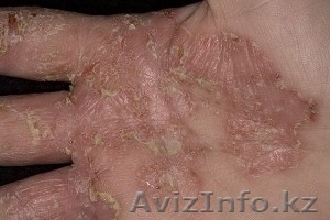 Лечение кожных заболеваний (экзема, дерматит, псориаз, ожоги). - Изображение #1, Объявление #1210912